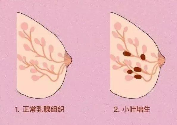 乳腺小叶增生广大女性的困扰