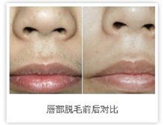 激光唇部脱毛效果好吗?