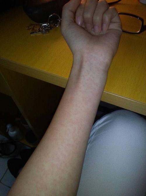 吃了牛肉之后身上长满了红斑,请问是过敏了