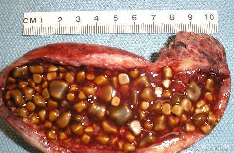 这也就是很多胆结石患者感到腹痛难忍的原因!