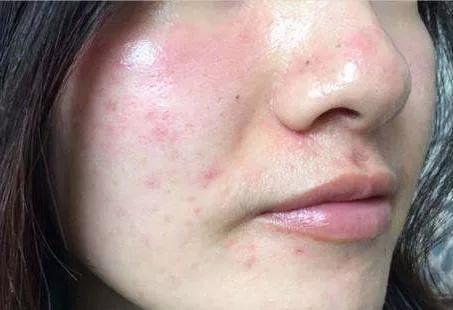 关于激素脸10问10答,激素脸多久能好?|皮肤管理