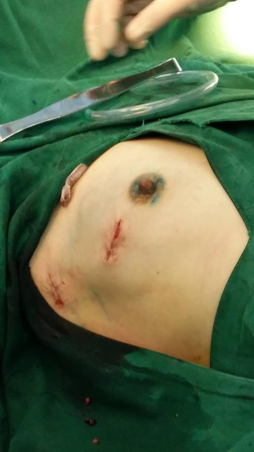 各项检查后,患者符合保乳条件,应患者要求,我们的医生从15:10开始手术