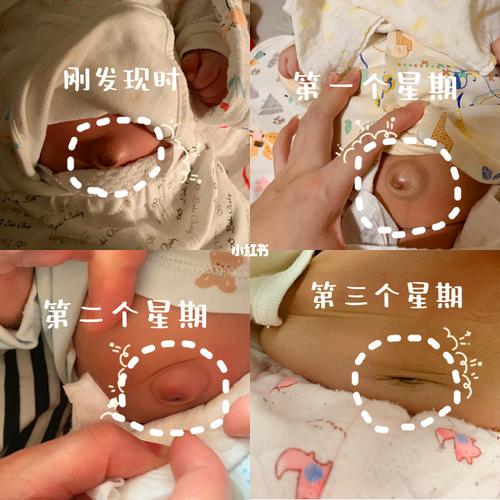 新生儿肚脐眼突出,脐疝解决方法
