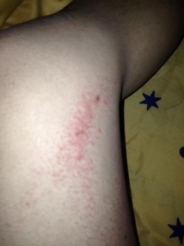 疥疮好了.大腿两侧长这个是什么.有时痛