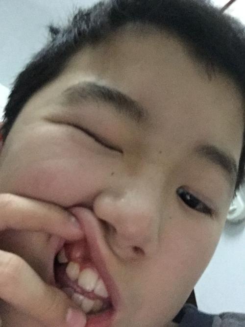 我口腔右上面牙肉上长了个硬硬的东西(不好意思拍照片