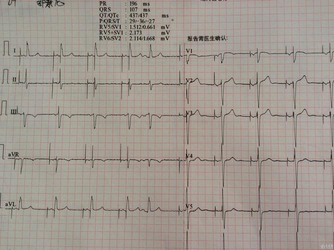 请教各位老师分析一下这份安装起搏器三年的起搏心电图