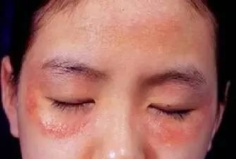 1,"干敏"——干敏的症状是敷面膜. 会刺痛,用水乳会刺痛.