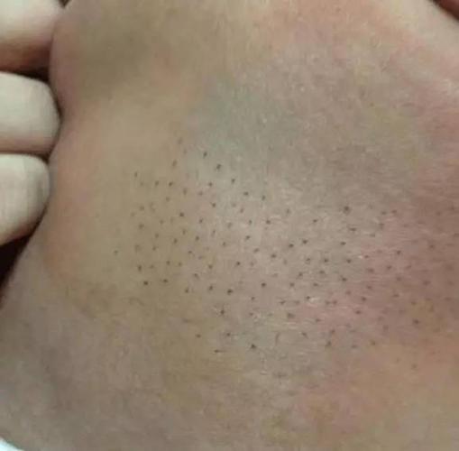 新生宝宝后背长黑毛,你听说过猪毛风吗?