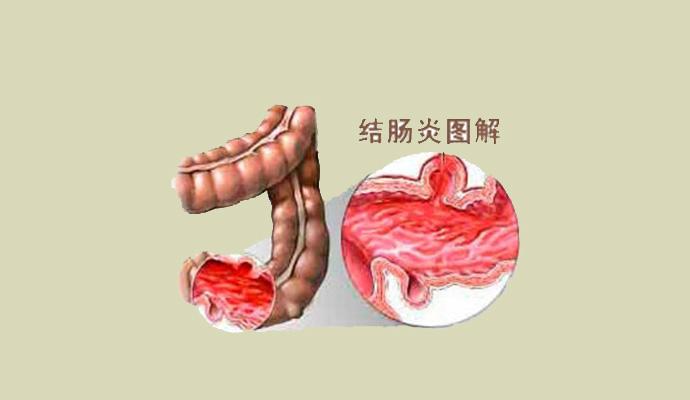 溃疡性结肠炎有哪些症状呢?