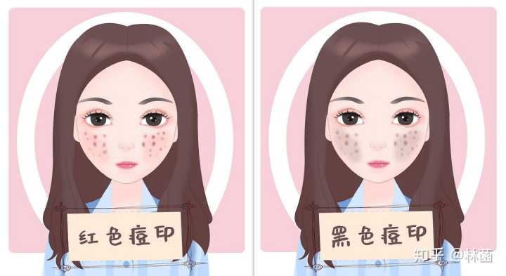 痘印分为红色和黑色痘印两种,这两种痘印的形成原因都会有所差异.