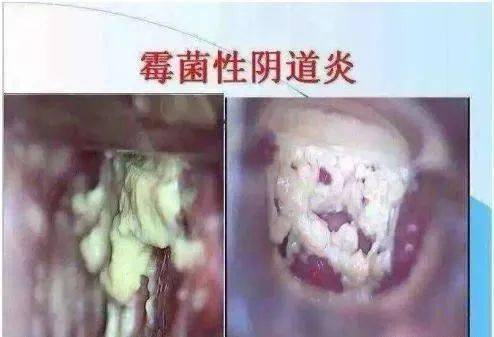 霉菌性阴道炎,是下面"发霉"了吗?