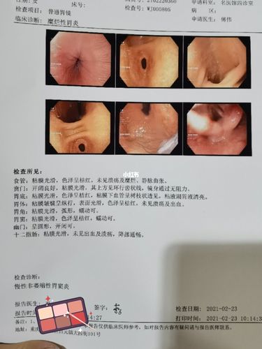 三年的第四次胃镜_胃痛_胃炎_胃病_医疗健康_医疗健康