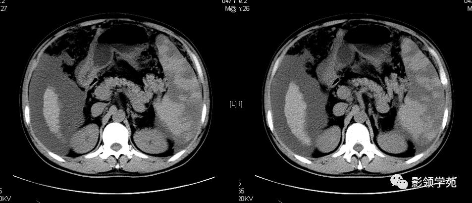脾脏正常ct及常见疾病影像表现