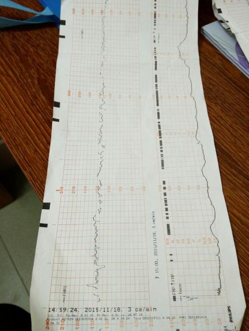 孕35周胎心监护医生说胎儿缺氧,要我马上住院,大家有没有这种情况!