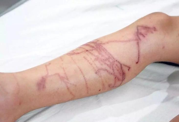 被水母蜇伤,用尿冲是绝对不行的