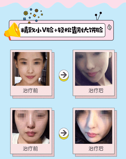 瘦脸针 轮廓紧致提升 颏肌放松 打造360°上镜小v脸 精准注射 正品