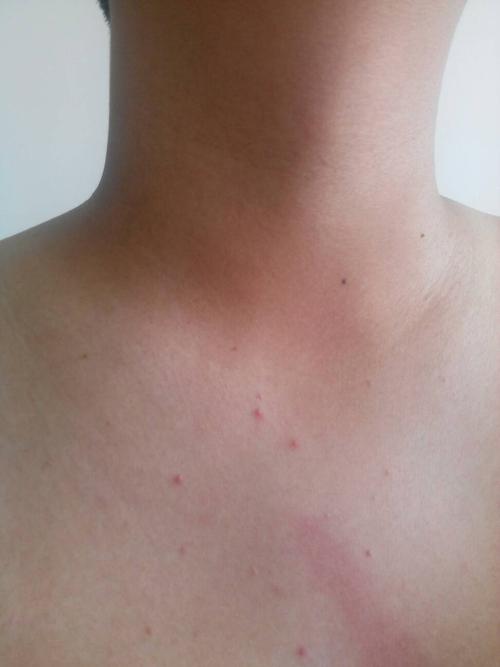 问:几天前发现身上出现这样的红色的疙瘩 请问医生这是什么 应该怎么