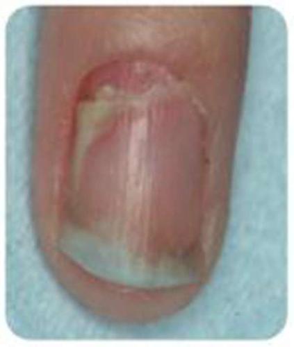 灰指甲挂什么科(教你如何治疗灰指甲)