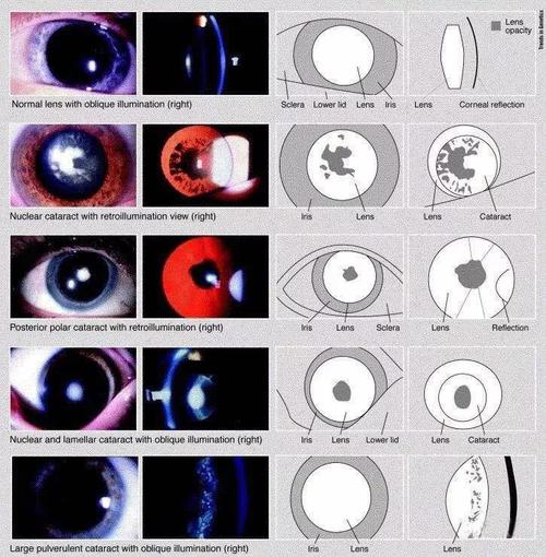 准妈妈注意了!很多新生儿因白内障痛失光明