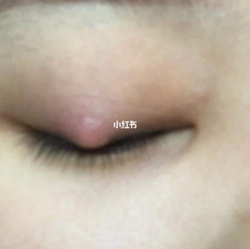 麦粒肿,发展全过程,一次悲惨的经历