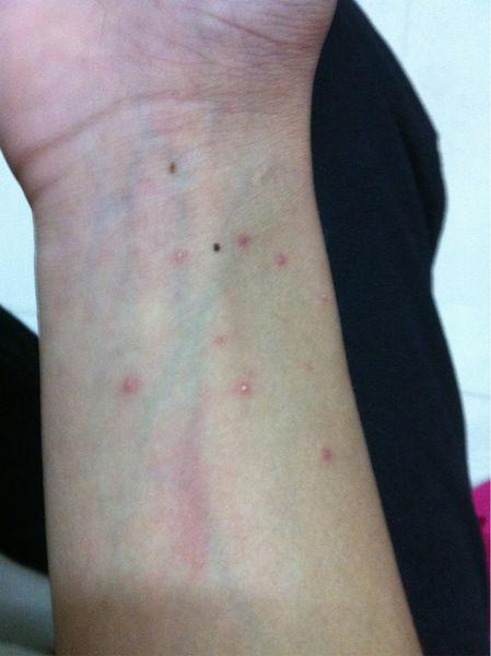 这是艾滋病皮疹吗,初期?