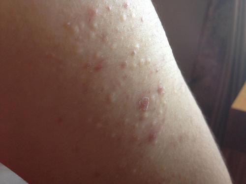 身上2个地方"长痘",或和艾滋病有关,生活中年轻人尽量