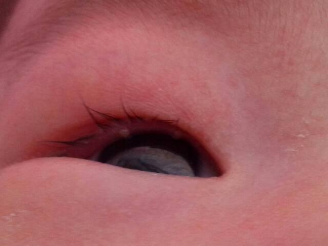 答: 问题分析: 根据您所说的情况,两个月大小的宝宝有上眼睑长疙瘩的