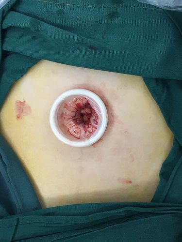 单孔腹腔镜!春风十里~~~不如你!