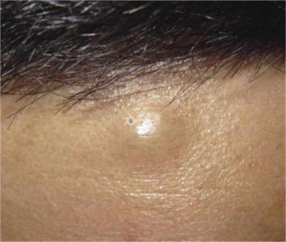 手臂皮下脂肪瘤图片