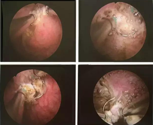 膀胱肿瘤术后一定要定期行膀胱灌注化疗一年,门诊密切随访,防止肿瘤