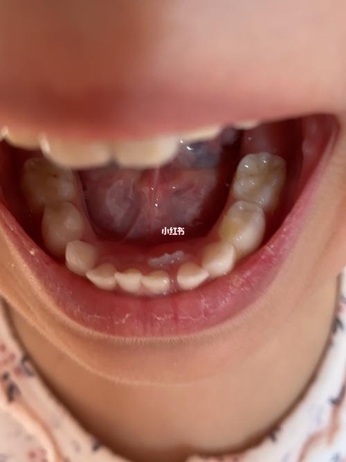 乳牙没掉,恒牙已经长出来了,有没有知道这个是怎么回事?