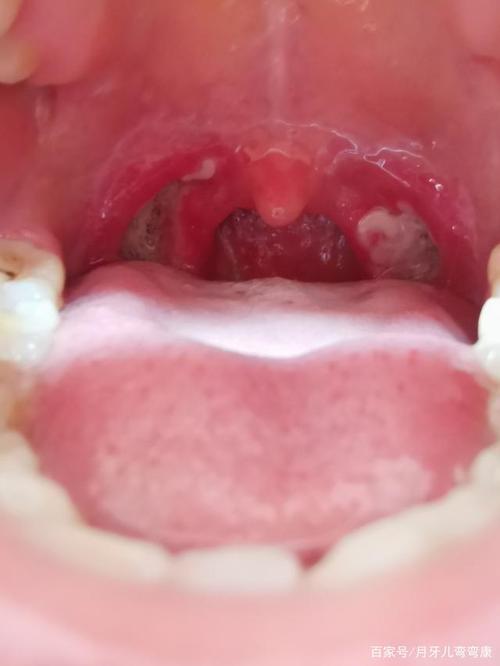 扁桃体术后第五天