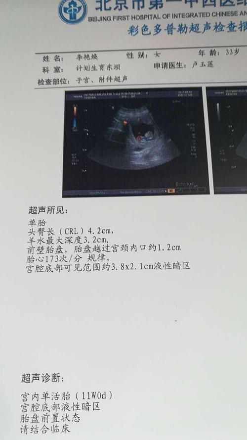孕11周,第三次做彩超了,以前就是有三厘米左右液性暗区没保胎也没出血