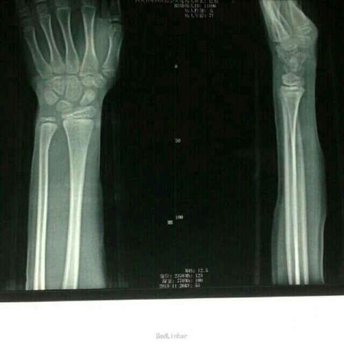 儿童桡骨下段青枝骨折手法治疗