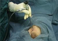 小儿疝气治疗小儿疝气手术,疝气治疗专科医院—宿州健安医院