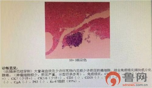 不开刀就能精准取得病理诊断,得益于这项技术