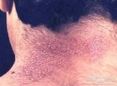 脂宁康治疗神经性皮炎效果怎么样