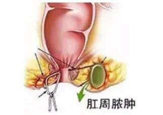丨肛肠科医生丨都是"痔疮"惹的祸?_肛门