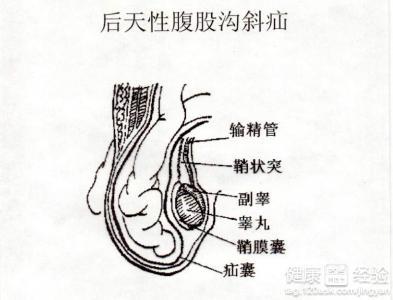 正文  概 述 腹股沟斜疝是一种外科疾病,多在腹部,多发于男性疝囊从腹