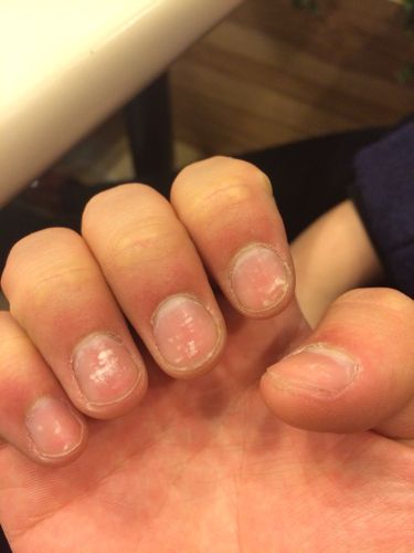 手指甲上面有白色的点点状!请问是缺什么营养吗?