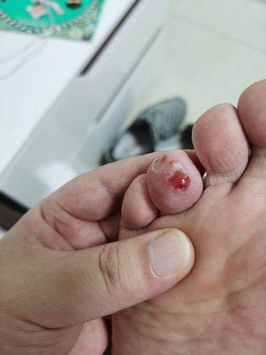 脚趾上长水泡,不痛不痒-男-40岁