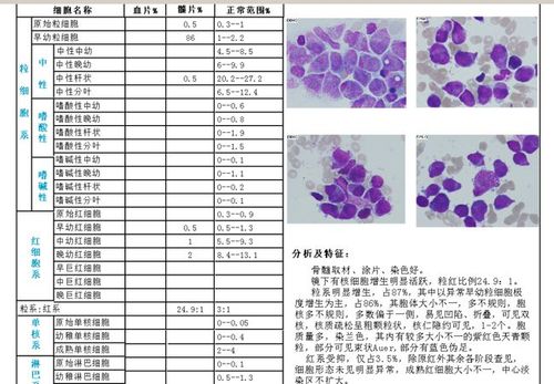 最易漏诊的白血病——低白m3|骨髓|粒细胞|白