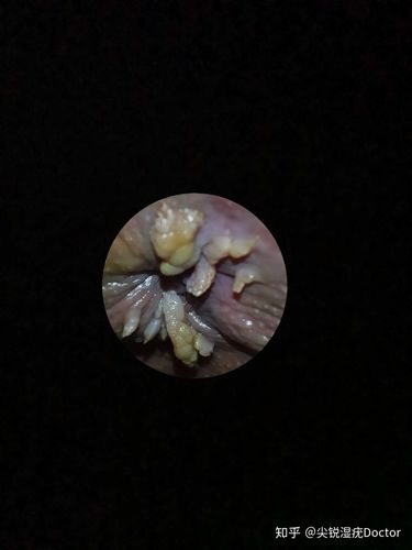 尖锐湿疣肛周疣体症状图片