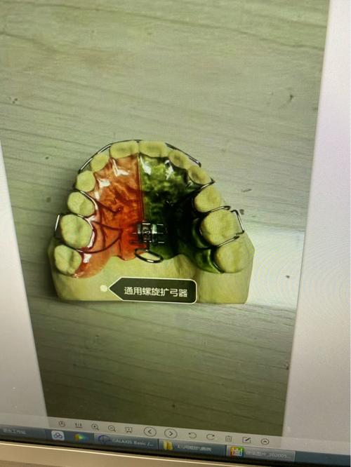关于上下牙拥挤之扩弓器_正畸_小朋友_口腔_牙齿保护