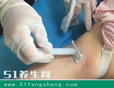 原来生孩子前的剃毛也可以叫备皮,但是备皮是指在手术的相应部位剃除