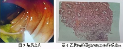 2.炎性息肉(图3和图4),肠粘膜受长期炎症刺激增生的结果; 3.
