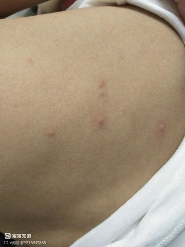两岁三个月宝宝,背上起了很多小疙瘩,硬,痒,一抓就破