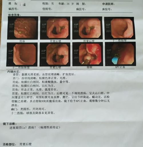 胃镜检查报告