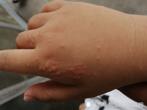 小米粒,沙土性皮炎