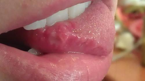 高危后口腔出现这"3病症", 或是艾滋病开始"侵犯"你